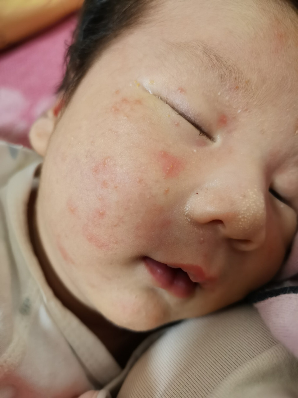 新生儿痤疮 宝宝刚出生的时候,脸上有几颗白色泡泡,就像图一额头上