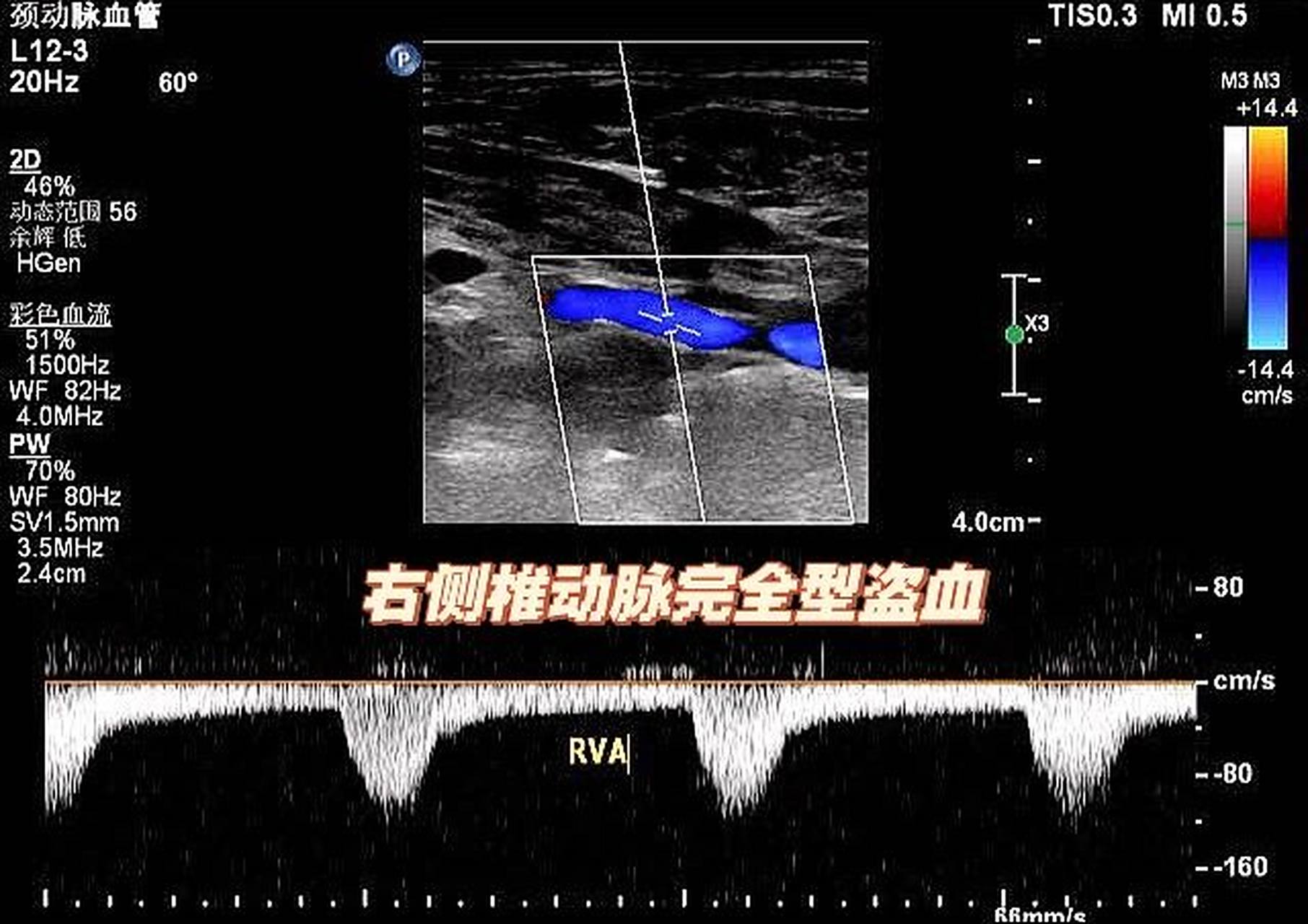 锁骨下动脉盗血综合征 3 这个病人给了我一个教训,看到锁骨下动脉的