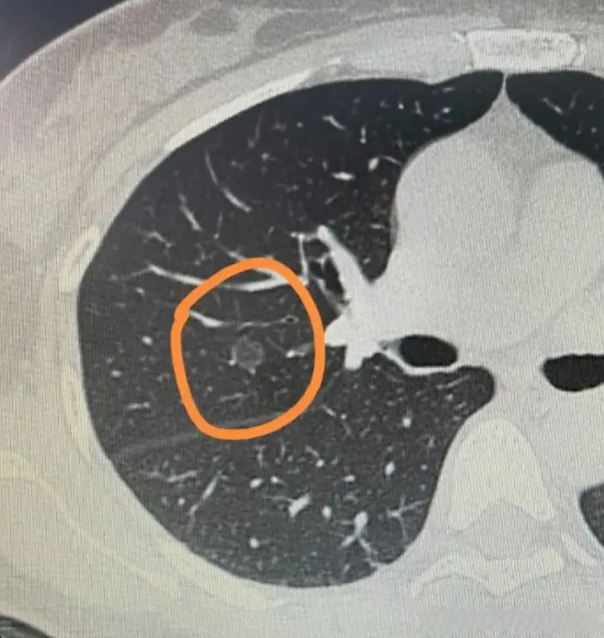查出肺气肿怎么办,还能活多久?这是一位粉丝朋友今天给我留的言.