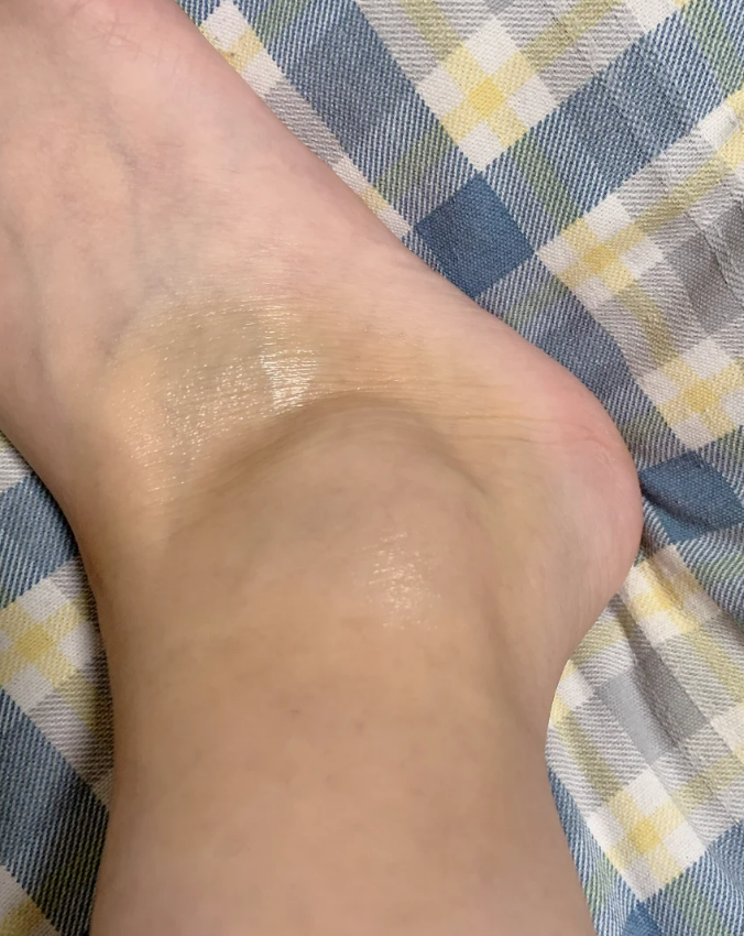 脚崴了没好全就别急着跑步