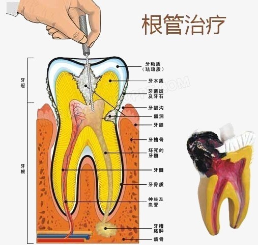 牙神经不能随便杀!牙疼的你快来看看!