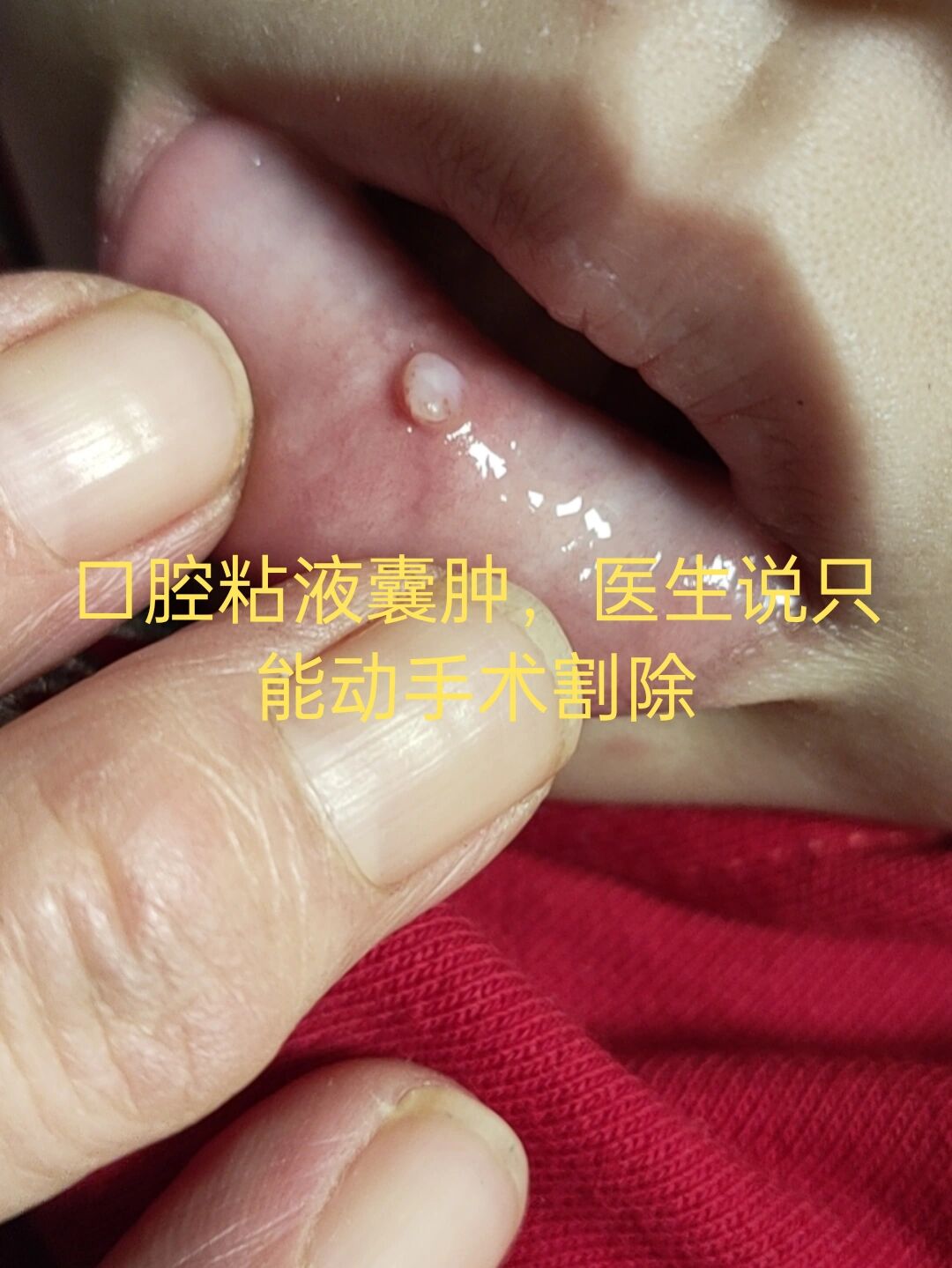 2岁宝宝_口腔粘液腺囊肿