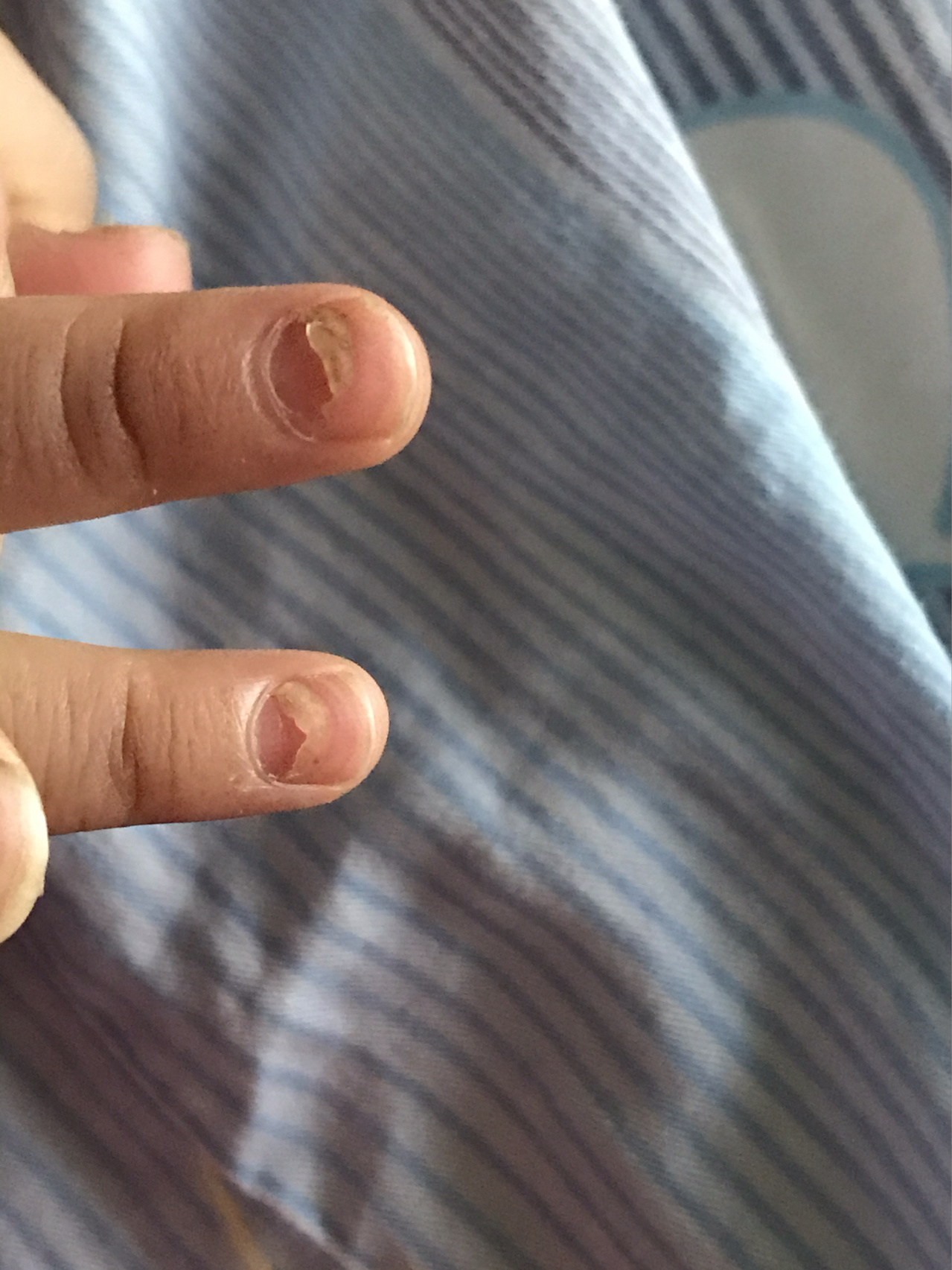 指甲壳脱落是什么原因
