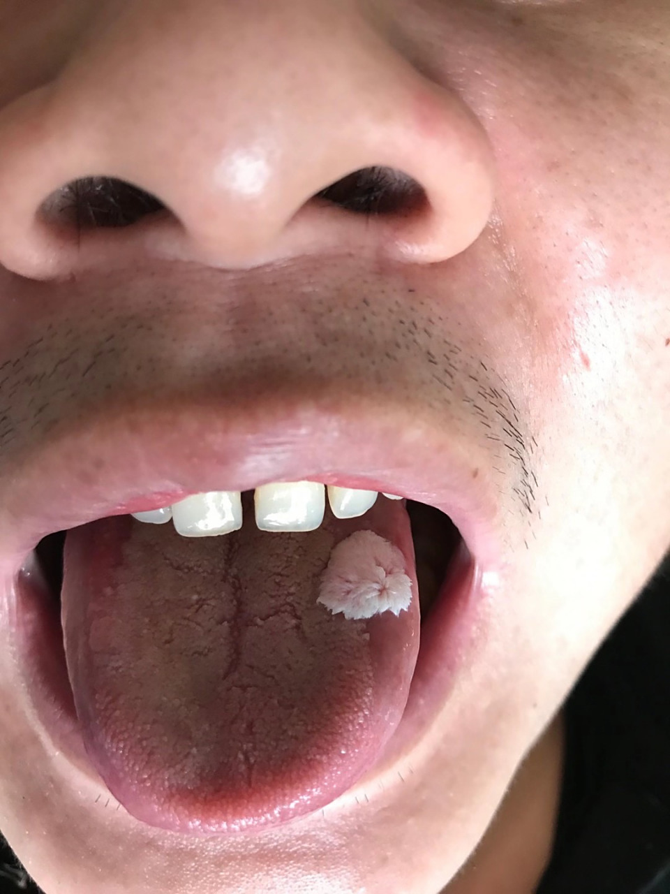 有习惯嚼槟榔的朋友,请尽快戒掉