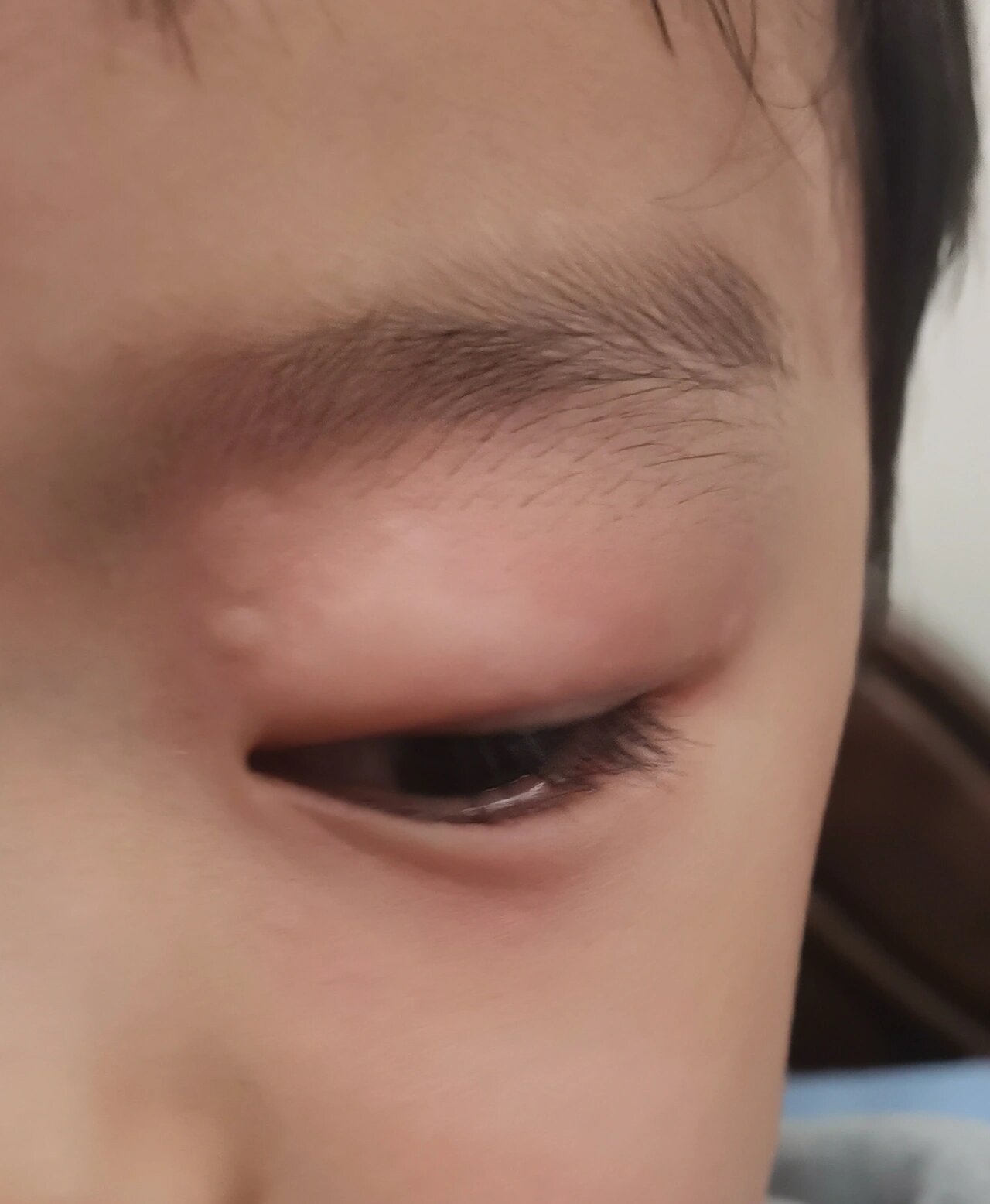 有姐妹知道小宝眼皮上起的这种疙瘩怎么回事 昨天下午