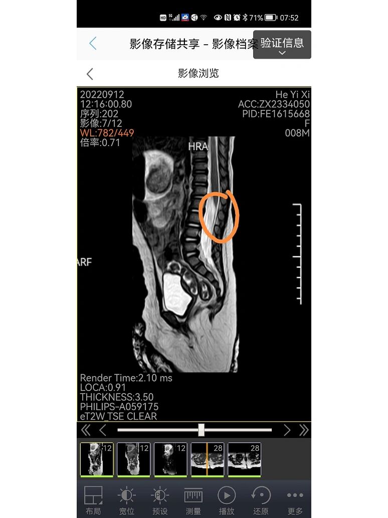 之前群里在讨论屁股上有洞,需要排除脊髓栓系的问题 吓得我扒开了两