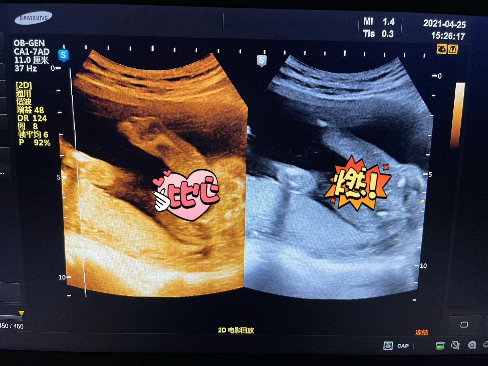 怀男宝症状:不盲猜了,直接上图!