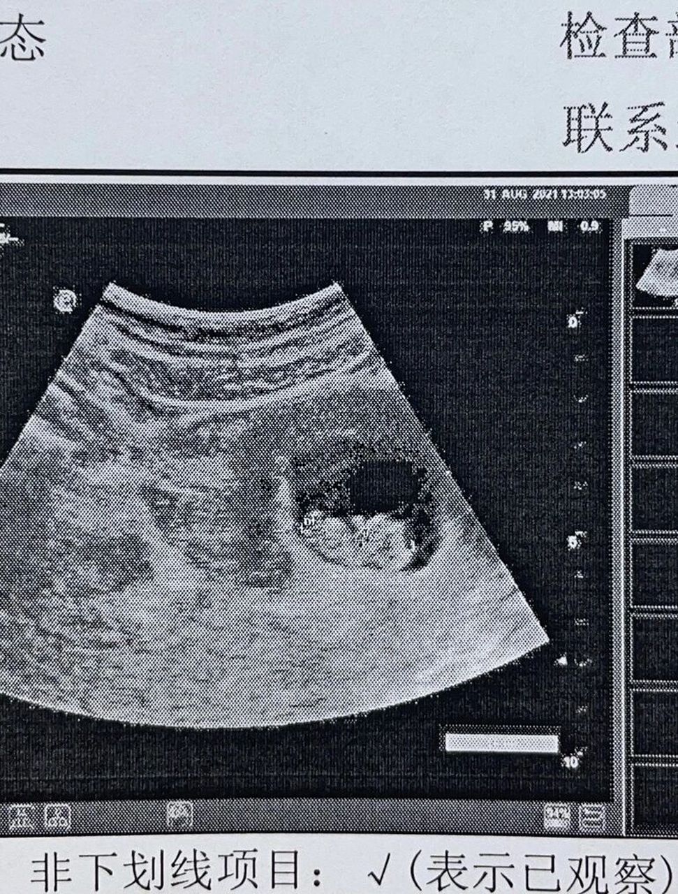怀孕9周女孩孕囊图图片