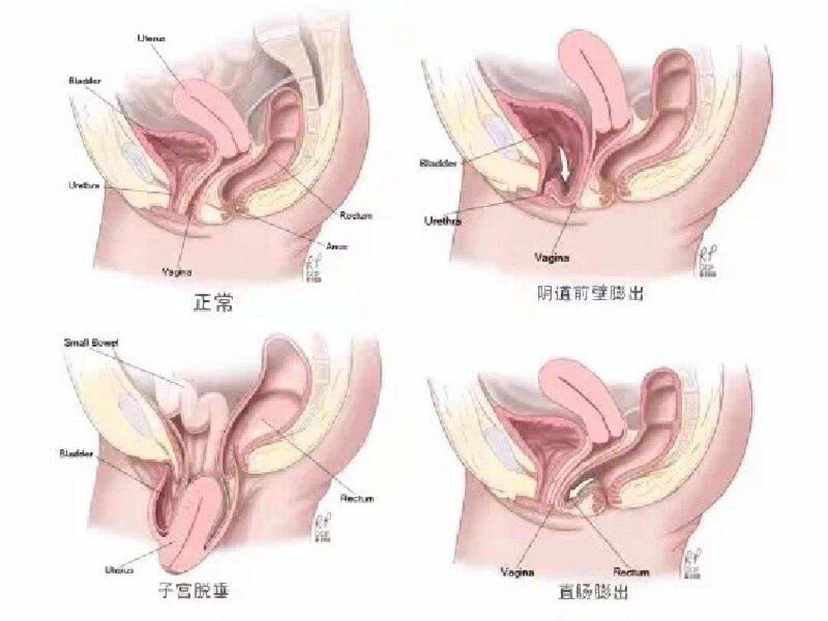 产后直肠膨出图图片