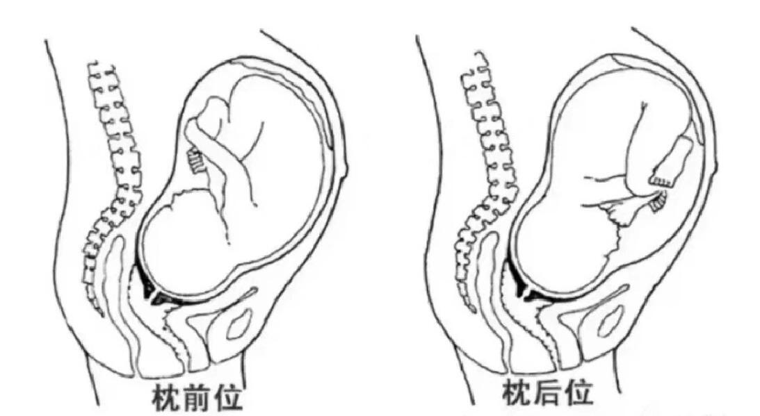 枕后位血泪教训 孕期不是要一直左侧睡