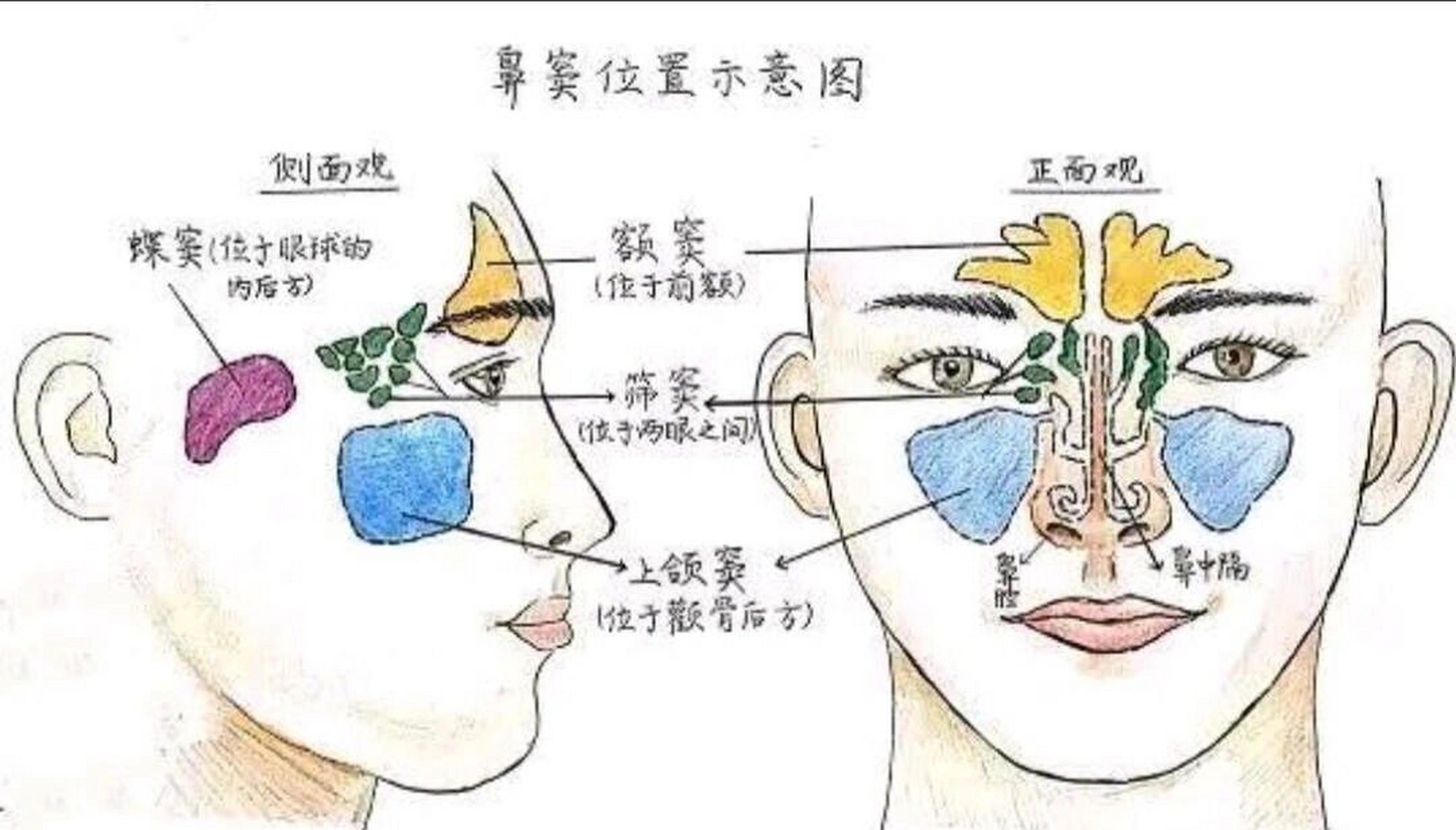 鼻窦炎可引起眼睛疼痛,特别是急性上颌窦炎,急性筛窦炎发作,可引起