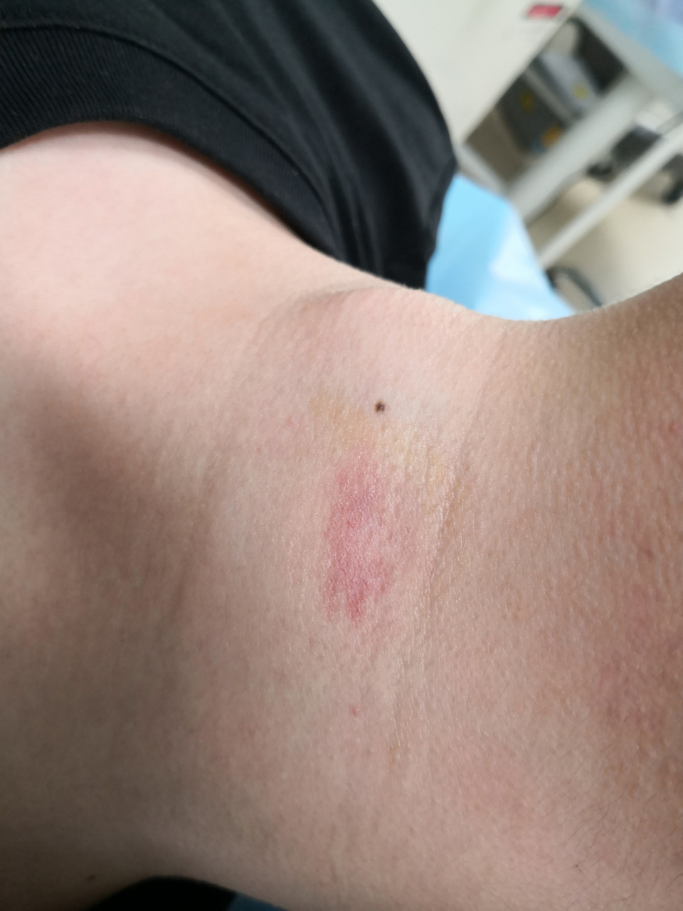 颈部的鲜红斑痣,激光治疗去除可以#鲜红斑痣