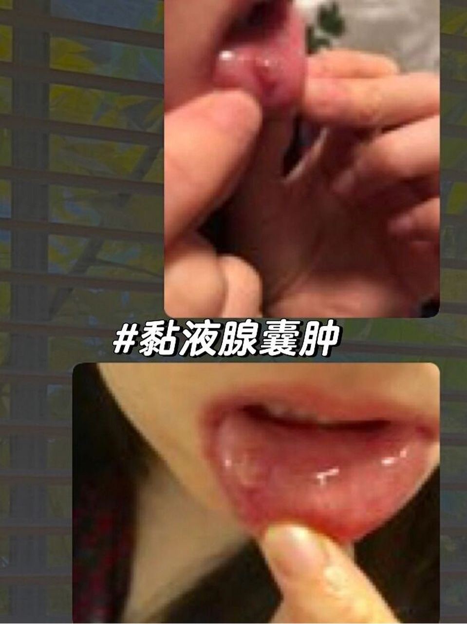 黏液腺囊肿|痛苦的自愈过程 两年前我得了黏液腺囊肿.