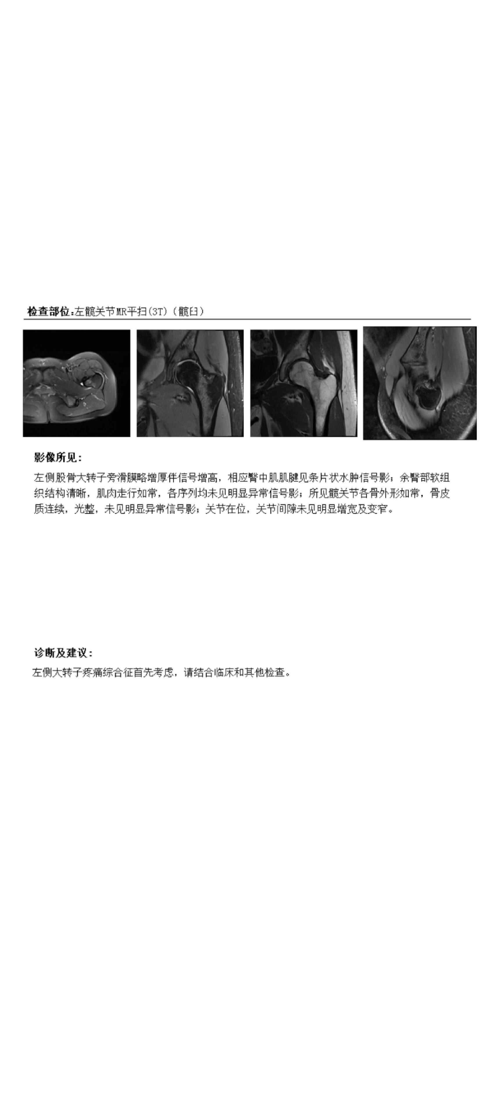 奇奇怪怪的病 左侧大转子滑囊炎71 吃药能好吗?