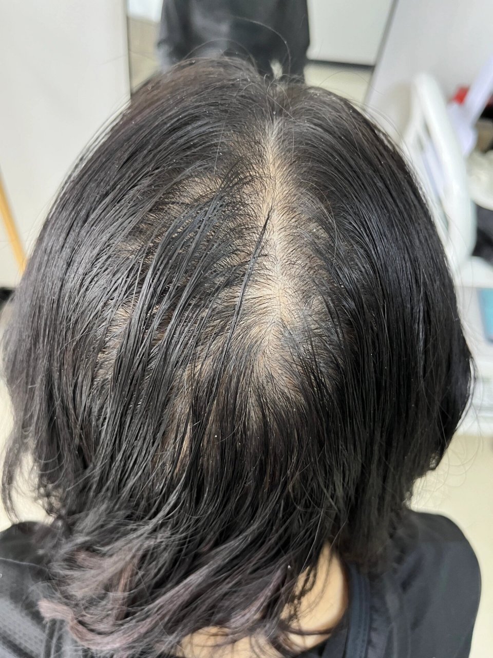 拯救头顶发缝宽大!