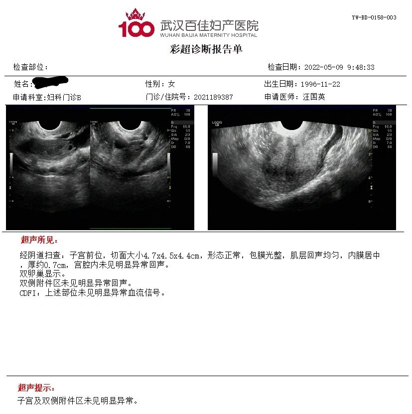 如何治疗女性盆腔静脉曲张 患者经常无诱因出现腰酸腰痛,小腹下坠