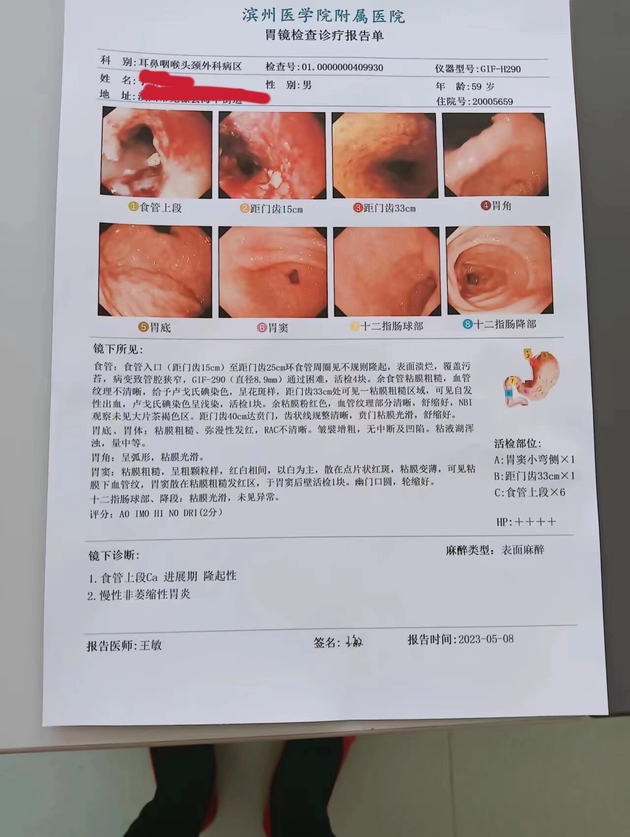 食管上端鳞状细胞癌