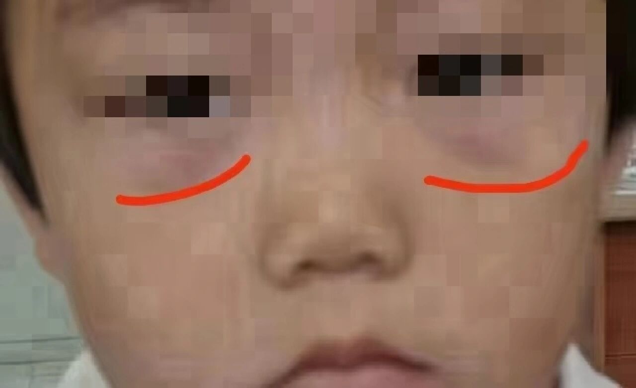 孩子眼袋有点暗紫为什么