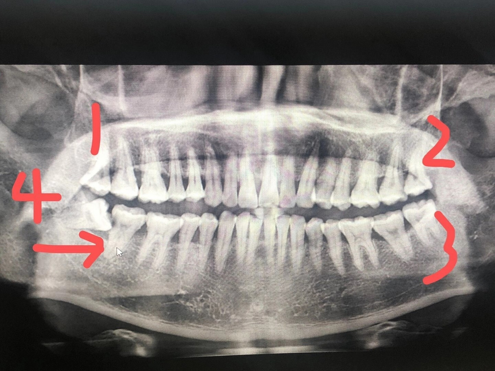 二货(同学)总是疑惑成人不是28颗牙齿吗,为什么自己一直以来数来嗜ゥ