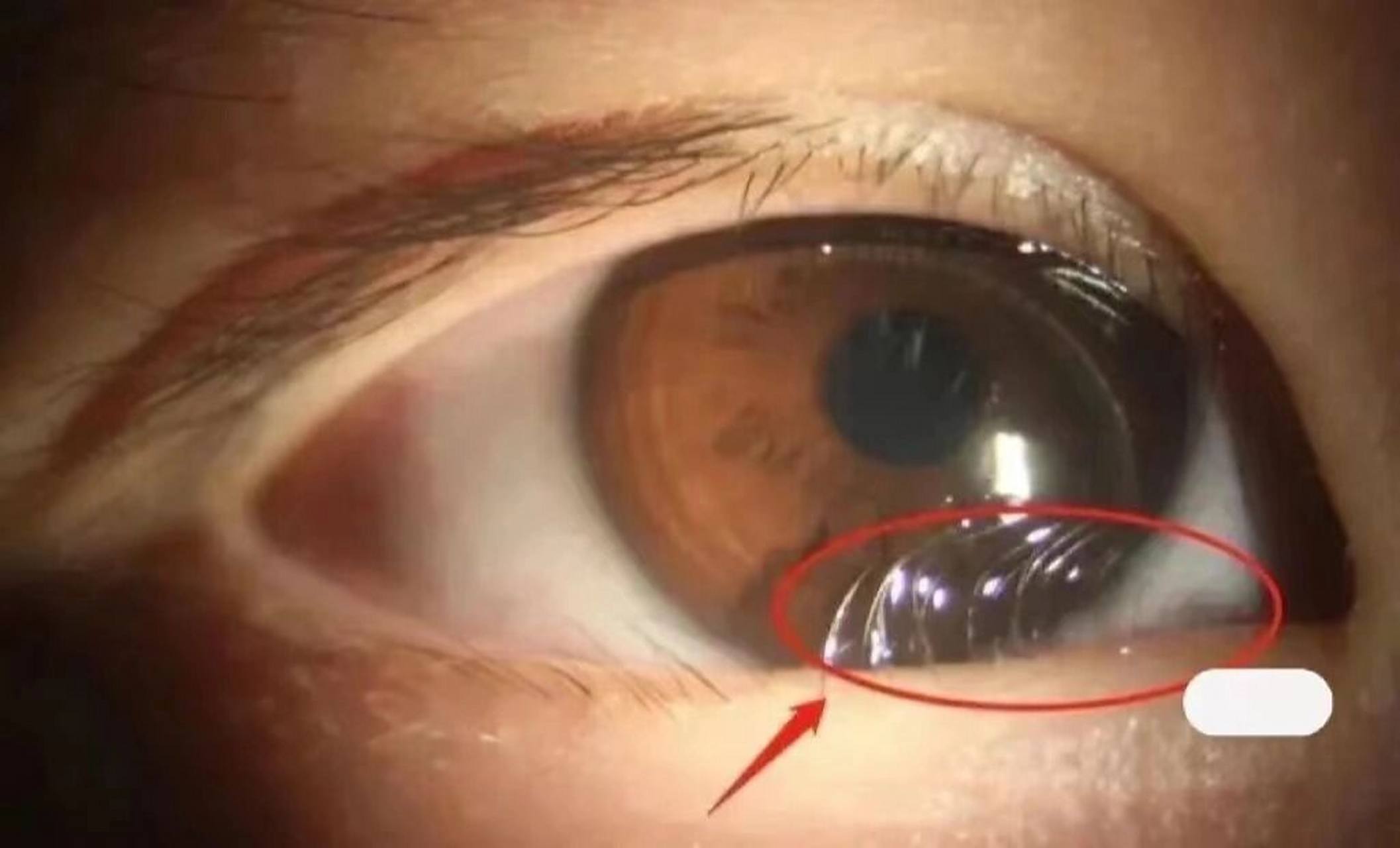 【睫毛倒向眼球的症状】 即是 倒睫.