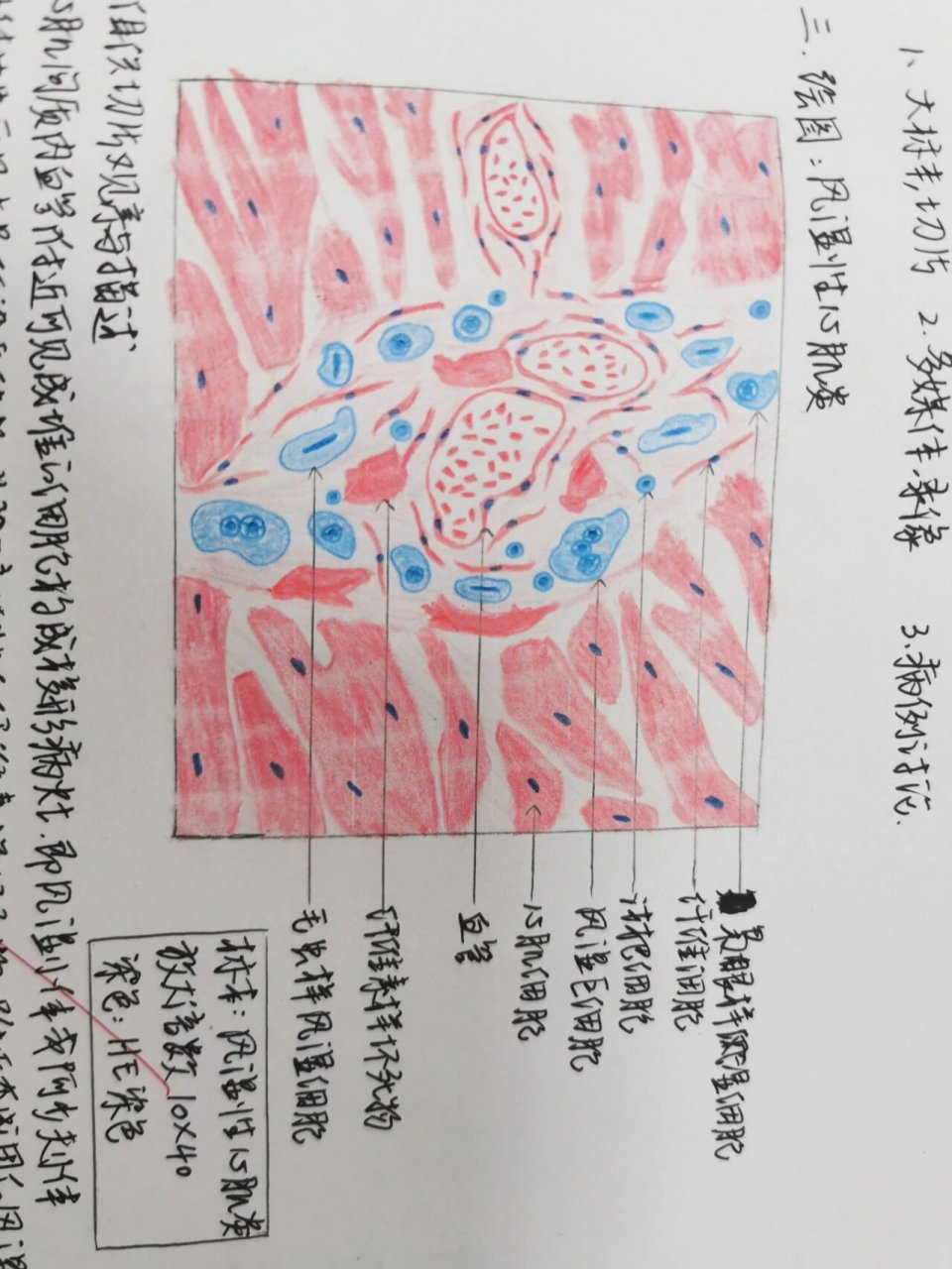 病理实验红蓝铅笔绘图3-风湿性心肌炎 【风湿性心肌炎】