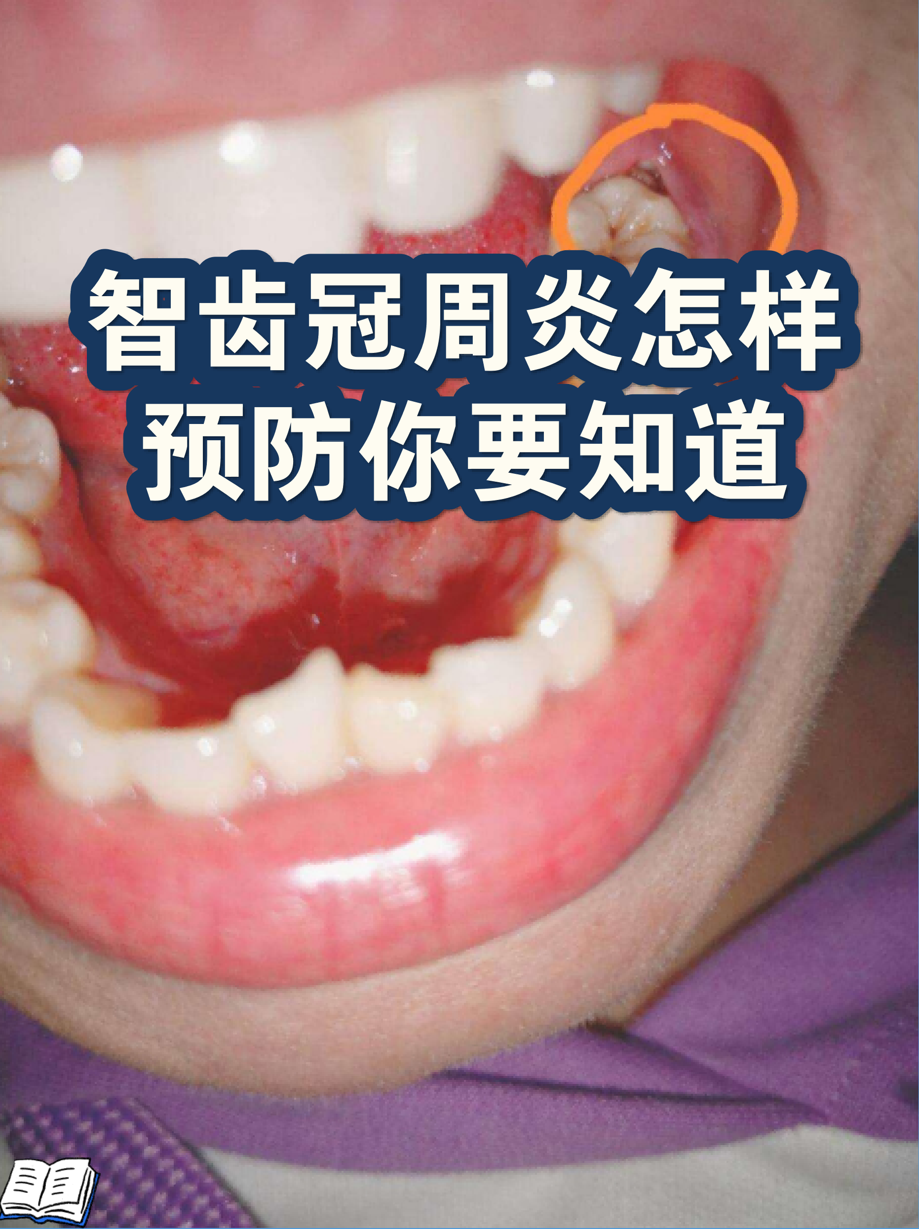 牙龈发炎图片(牙龈发炎图片症状图片)
