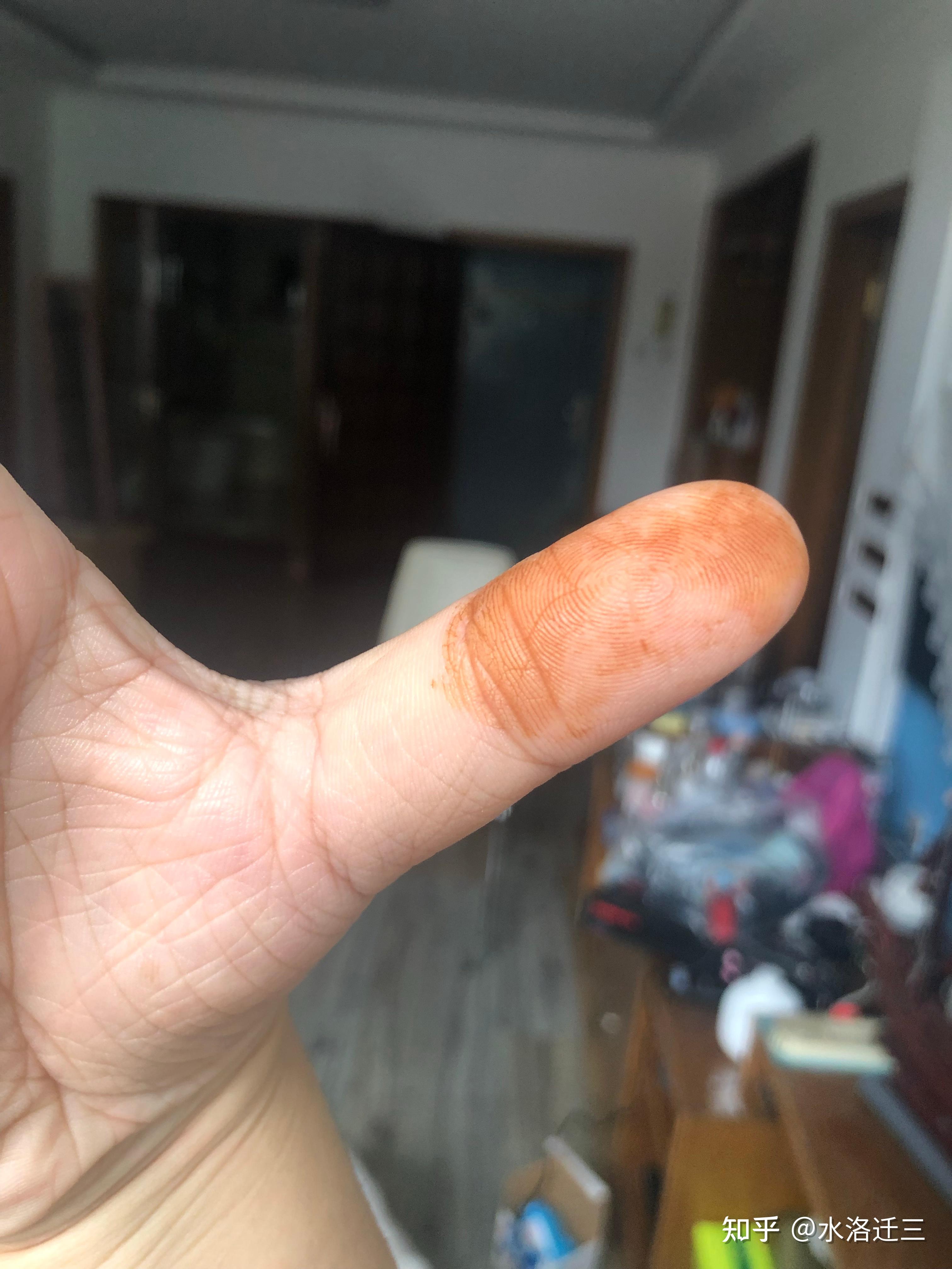 一觉醒来手上有铁锈一般的黄色块洗不掉