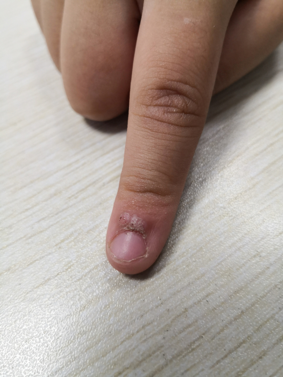 甲周疣激光治疗配合药物涂擦能够比较快的治疗.