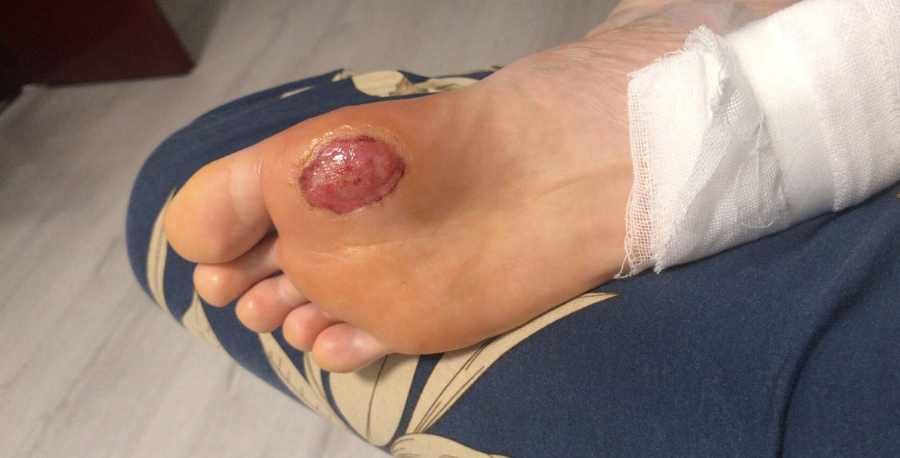 014月底做的激光除鸡眼,由于自身换药问题,经历了化浓,吃药引起