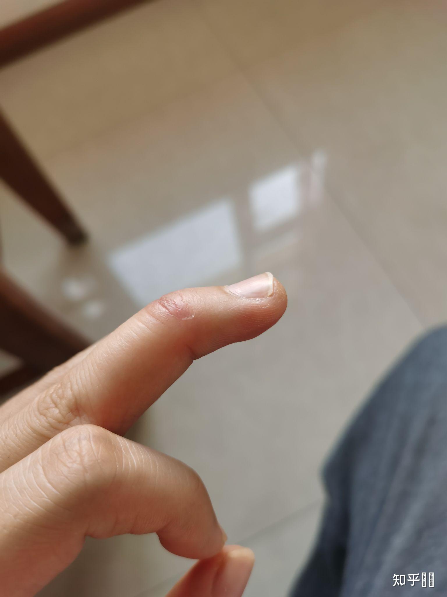 打篮球时手指戳伤不能伸直求有经验的大神告诉我这是否严重啊