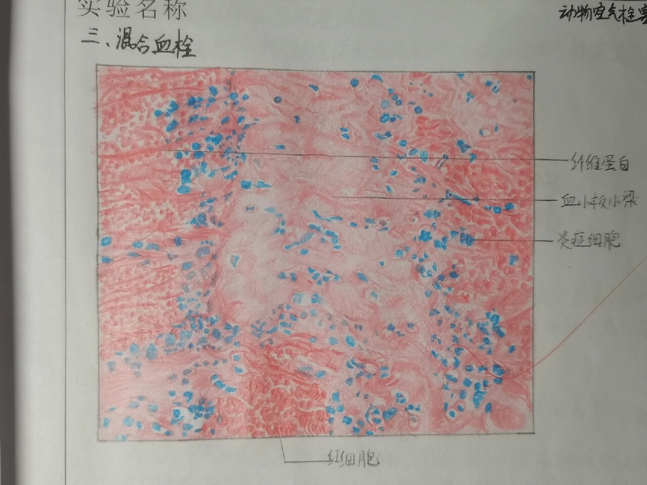 慢性肝淤血 2.慢性肺淤血 3.混合血栓