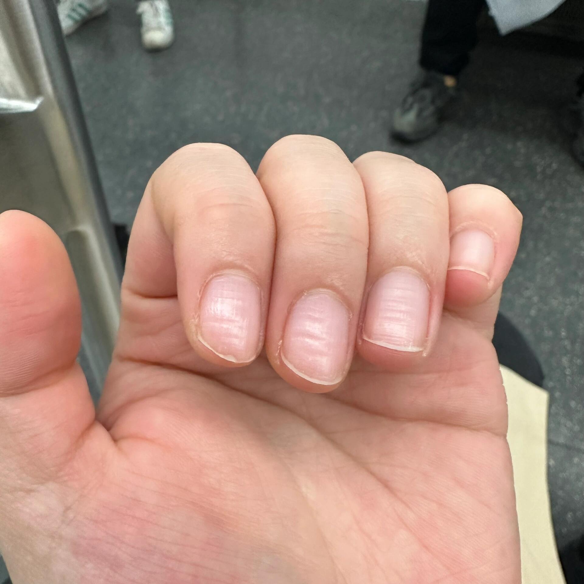 指甲上有波浪横纹是为什么 求助万能的小宝宝,指甲上有波浪形的横纹是