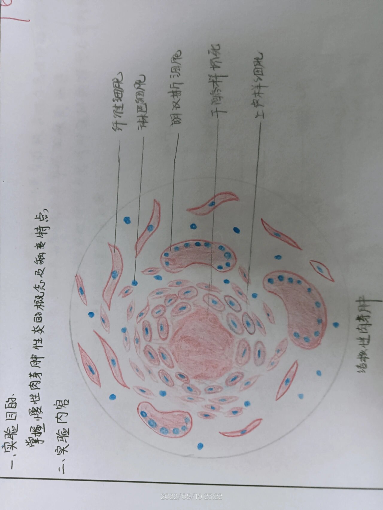 结核结节病理手绘图图片