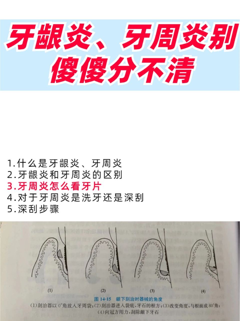 牙龈炎,牙周炎别傻傻分不清,教你看牙片!
