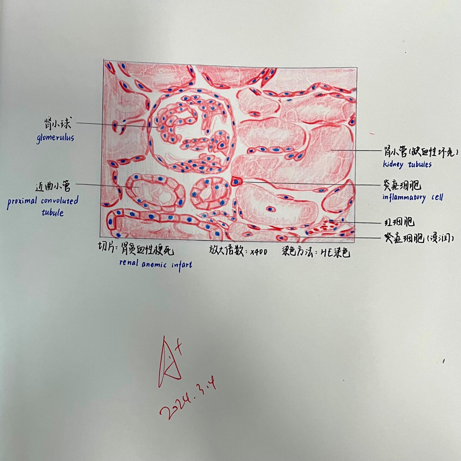 肾贫血性梗死红蓝绘图图片