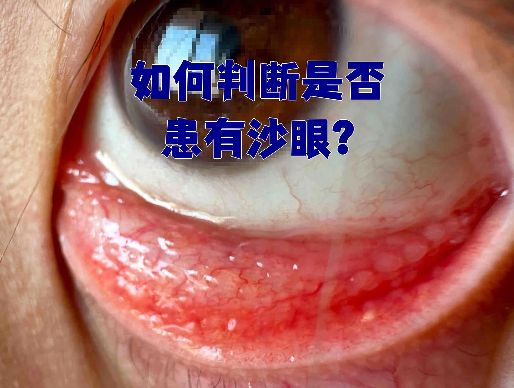 要判断是否得了沙眼,主要看两个方面的表现:症状和检查结果