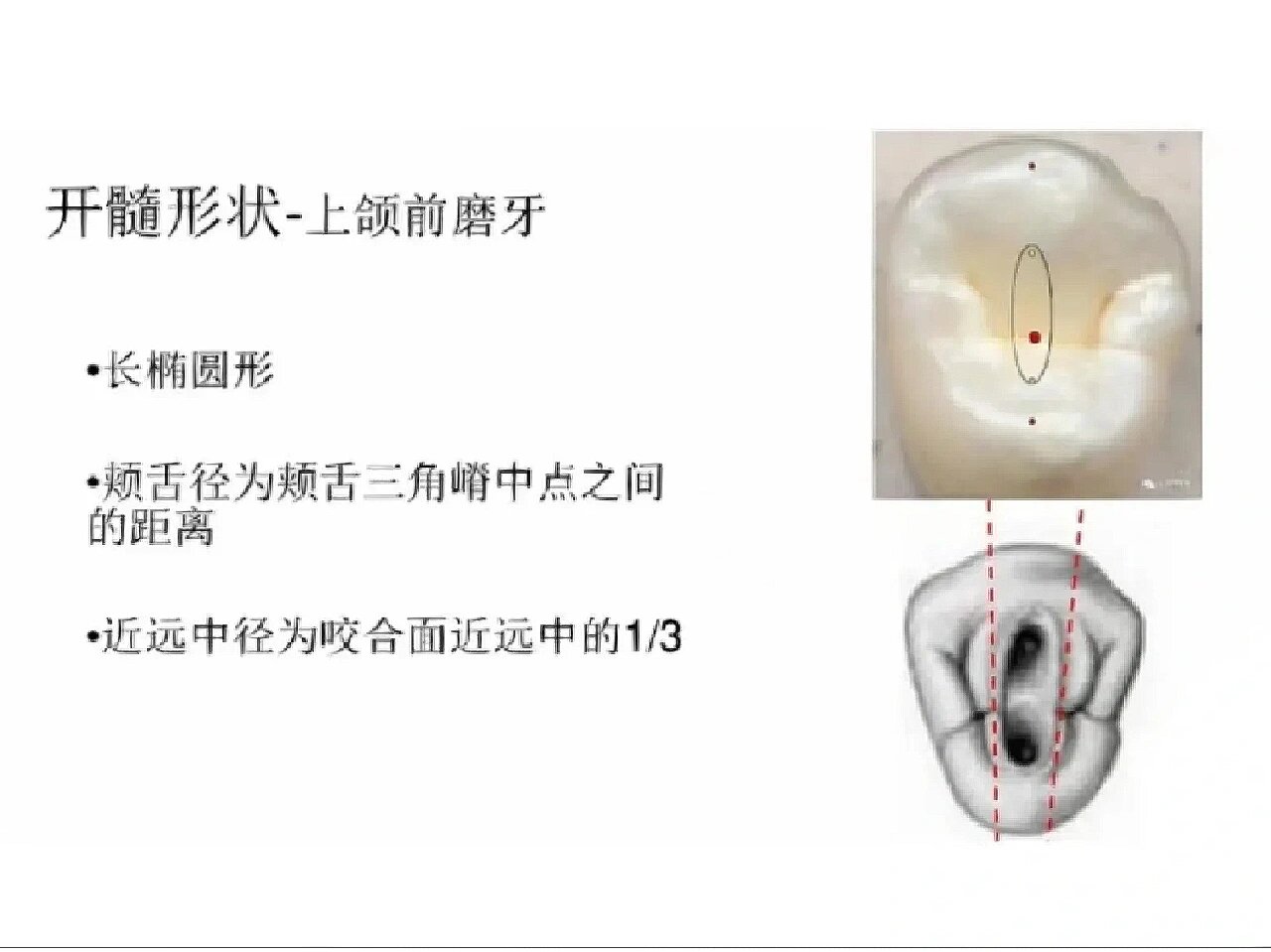 下颌六的开髓形态图片图片