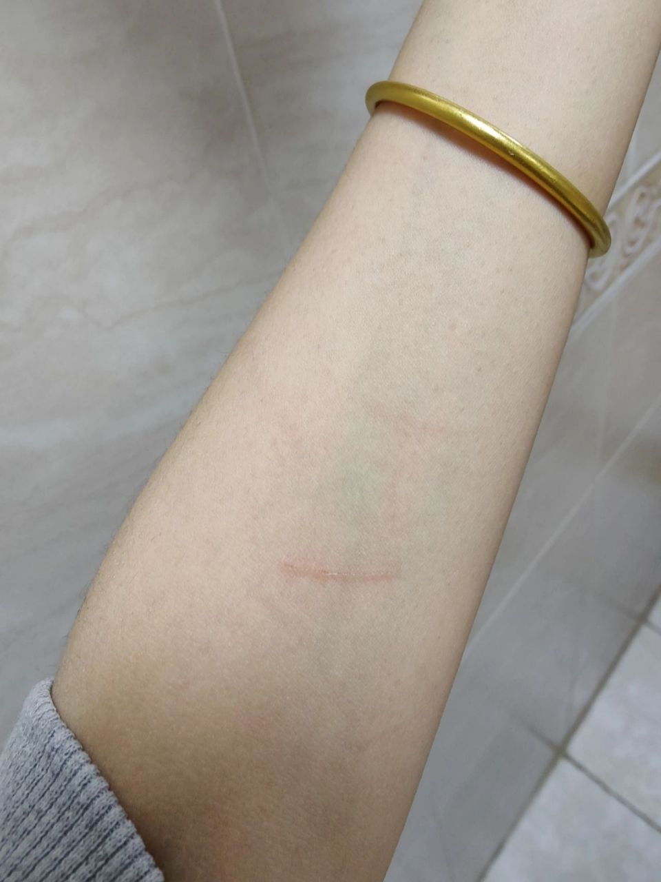 被一个月多的小狗抓伤 身上好多这样的伤口,不知道要不要打狂犬疫苗