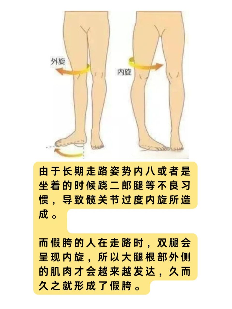 真正导致假胯宽的原因是:髋关节联结不对位.