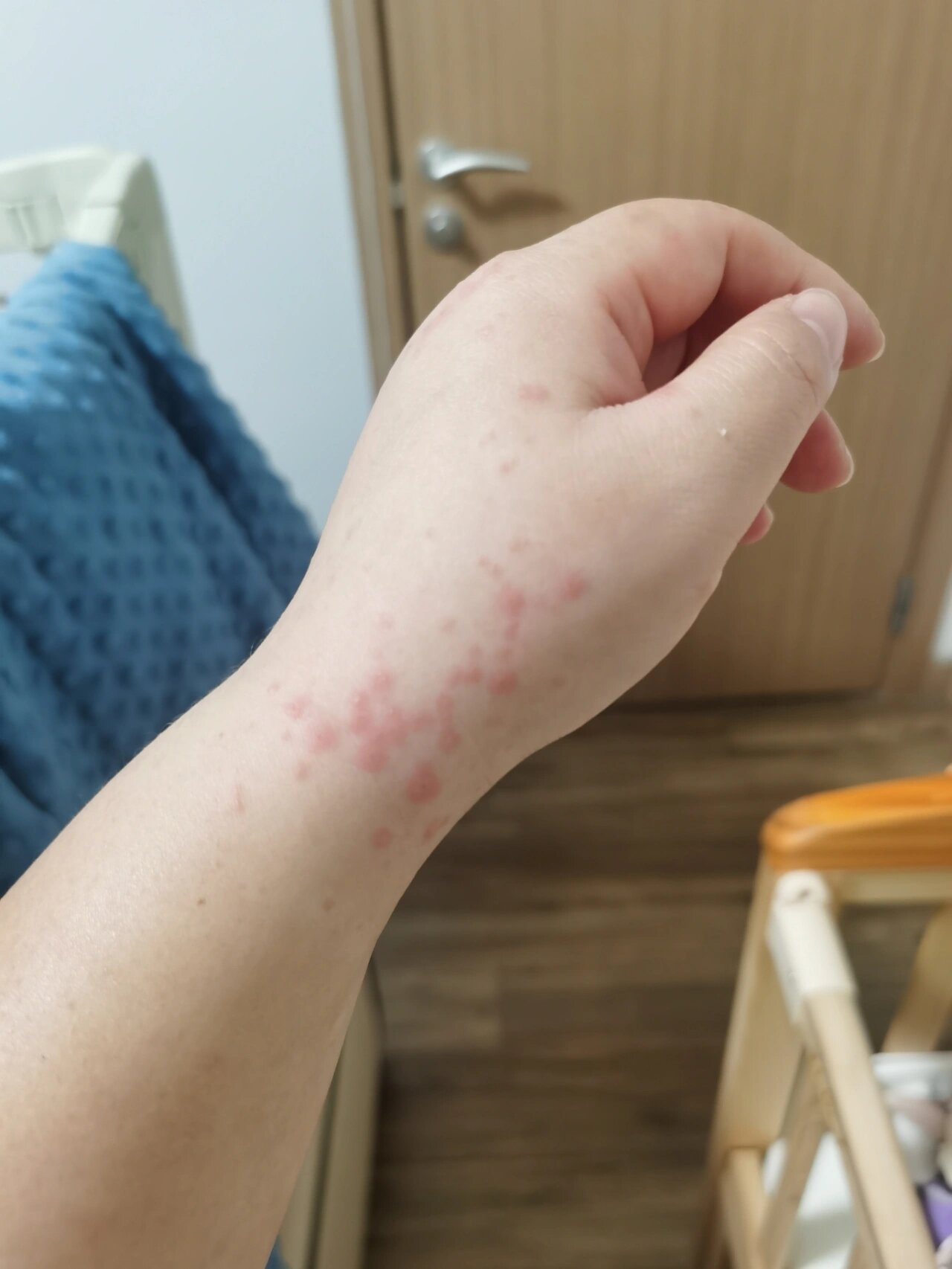 新冠后皮疹 今天是感染新冠第十天,已经转阴了 但是