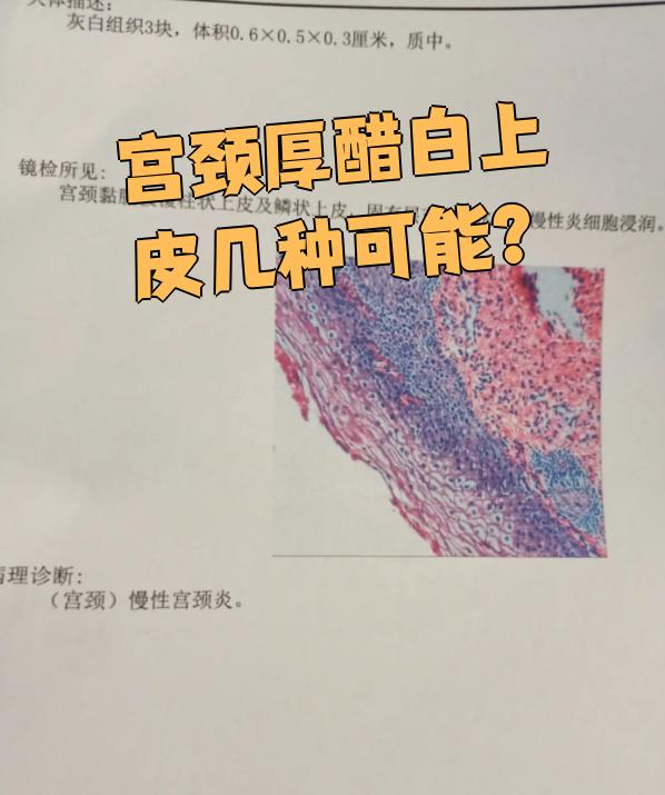 宫颈厚醋白上皮通常指的是宫颈厚涂片检查中发现醋酸白上皮