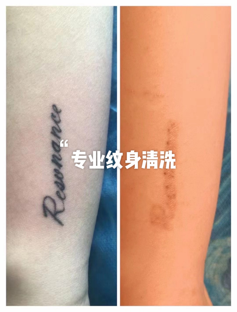 专业洗纹身 不只是洗淡 是可以彻底除掉的 选对专业的人士清洗 好好的