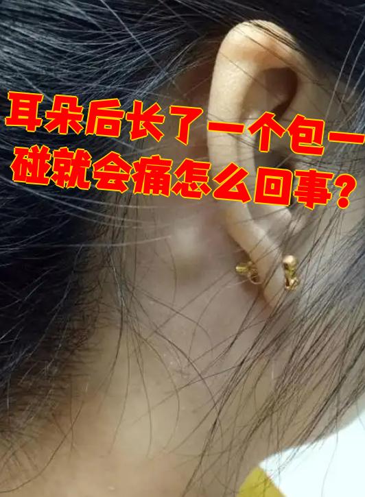 耳朵后面长了个包,一碰就疼,最常见的原因是毛囊炎或皮脂腺囊肿