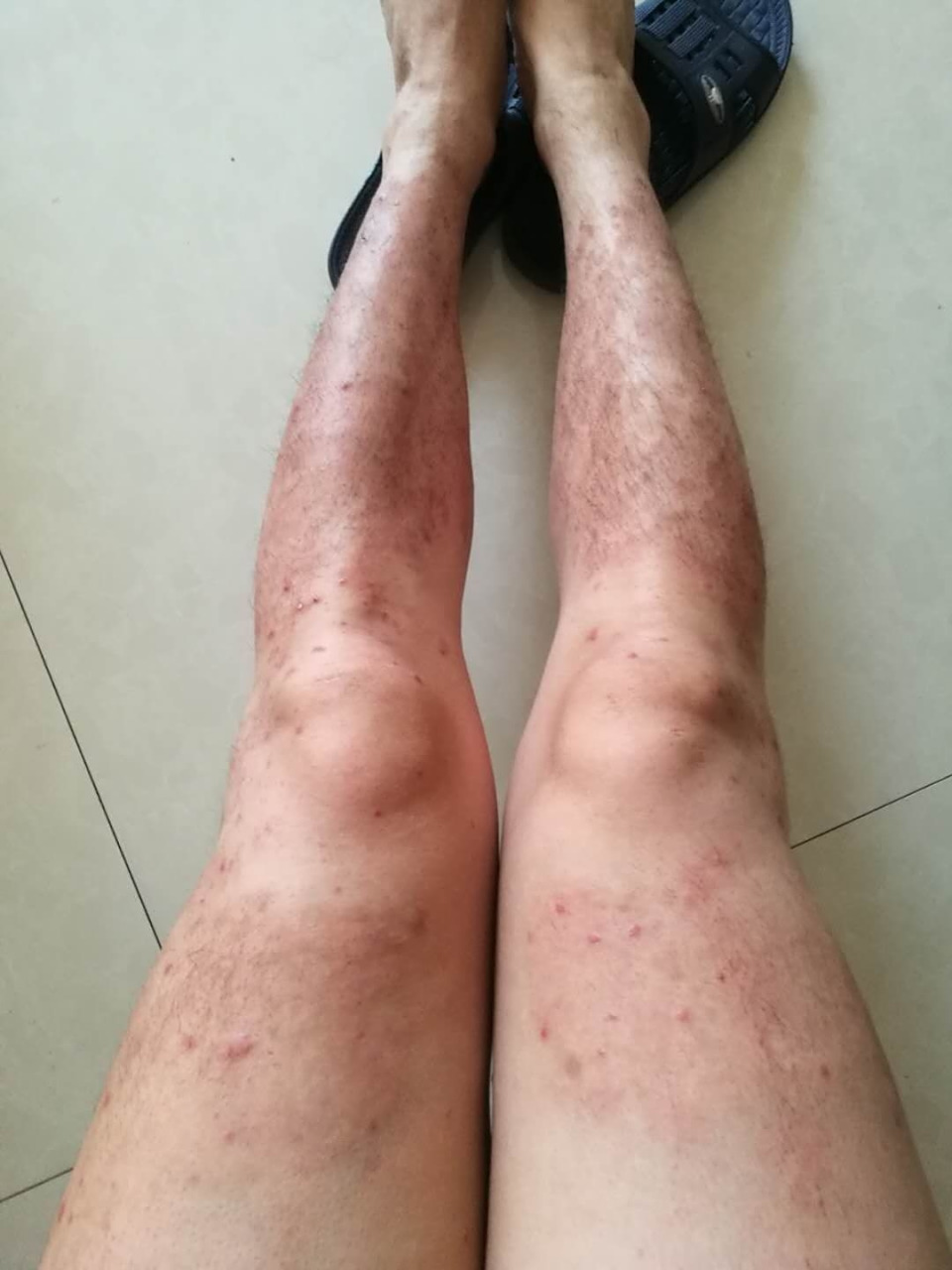 第一张腿上全是黑色印子.这个患者前两年是第一张的情况.