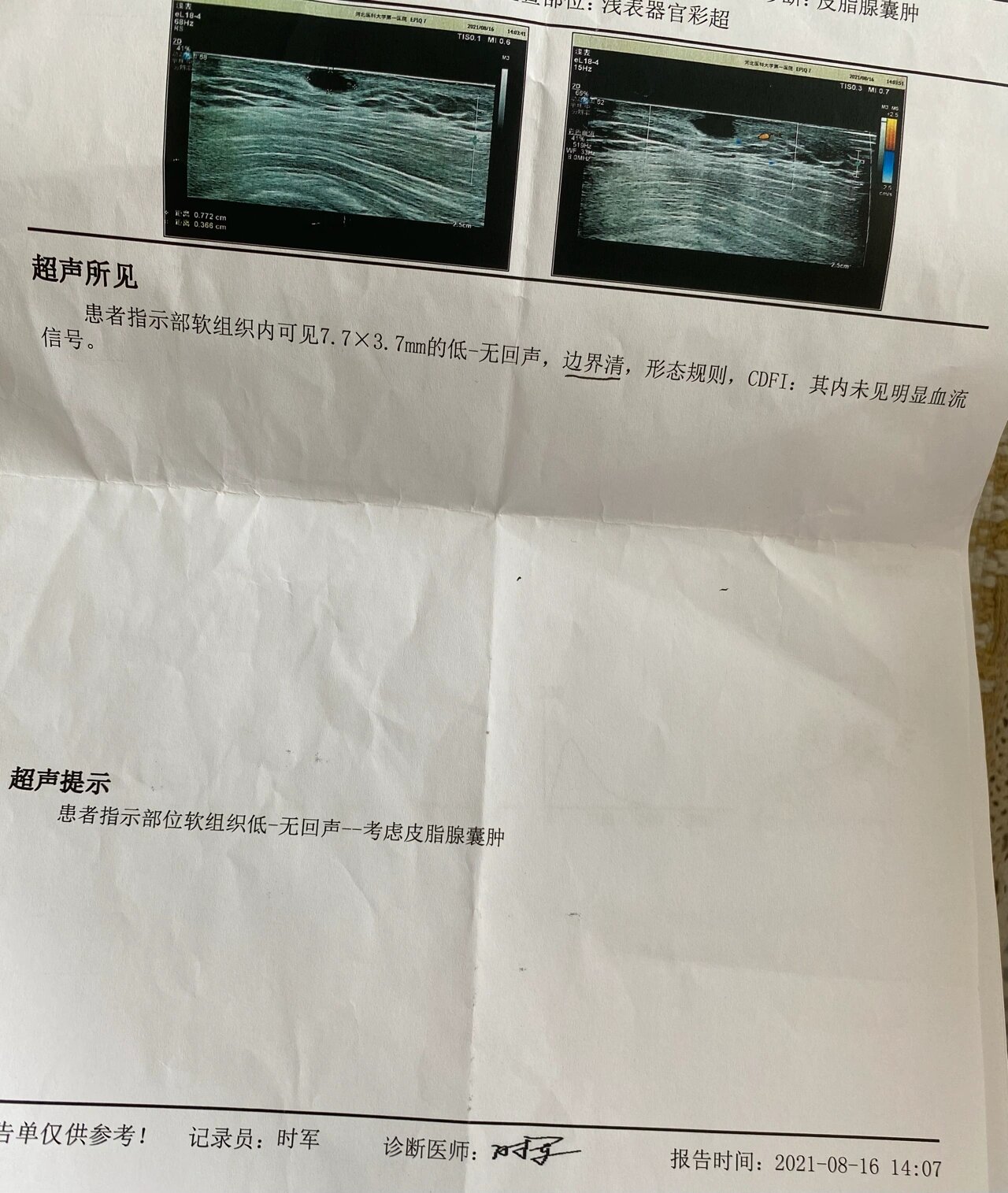 分享腋下皮脂腺囊肿手术全过程