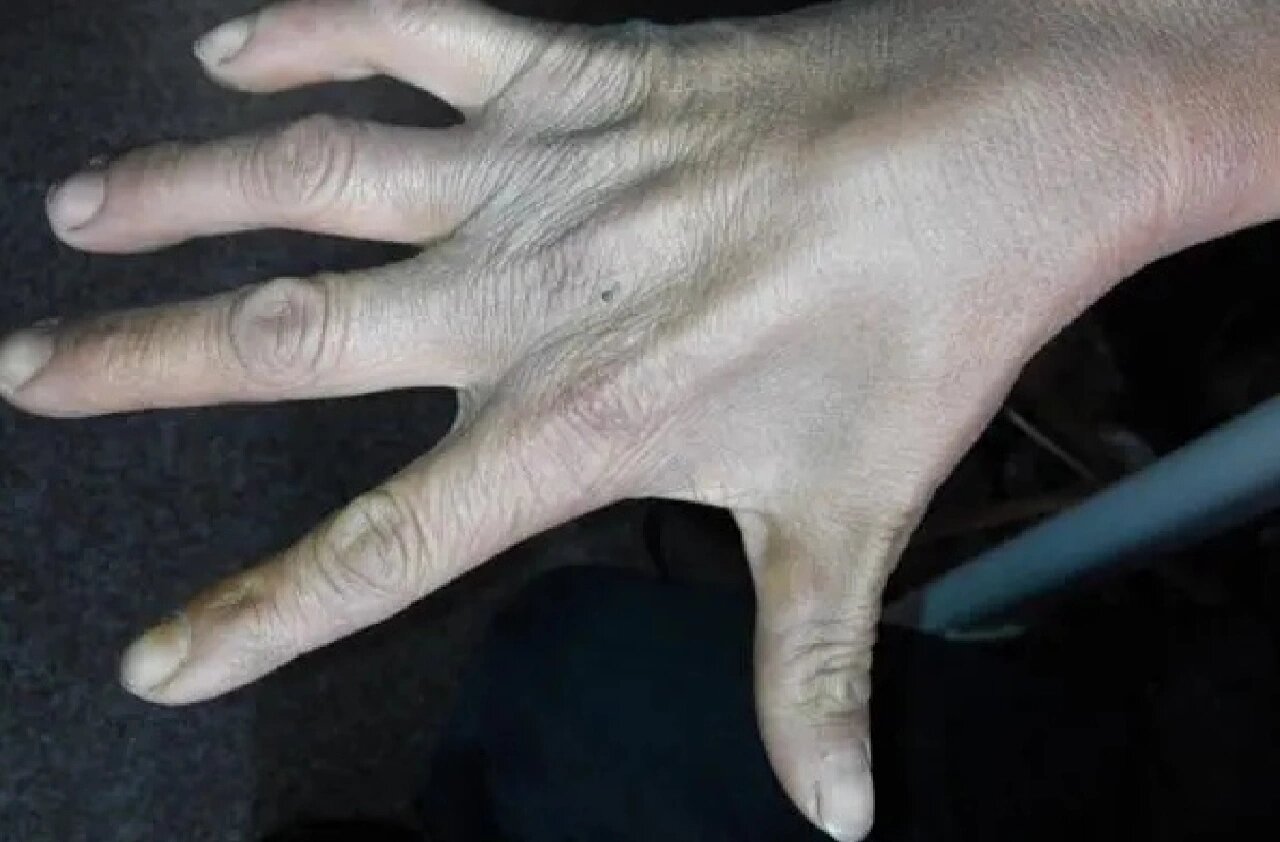 男性多见,主要症状表现为手及前臂无力,随后出现手部肌肉萎缩,以