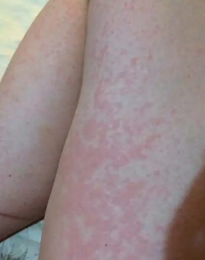 吃桃子会过敏吗,都有什么症状?