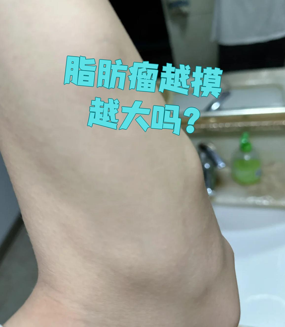 脂肪瘤不会因为经常摸就变大,但如果发现肿块明显增大,一定要及时去