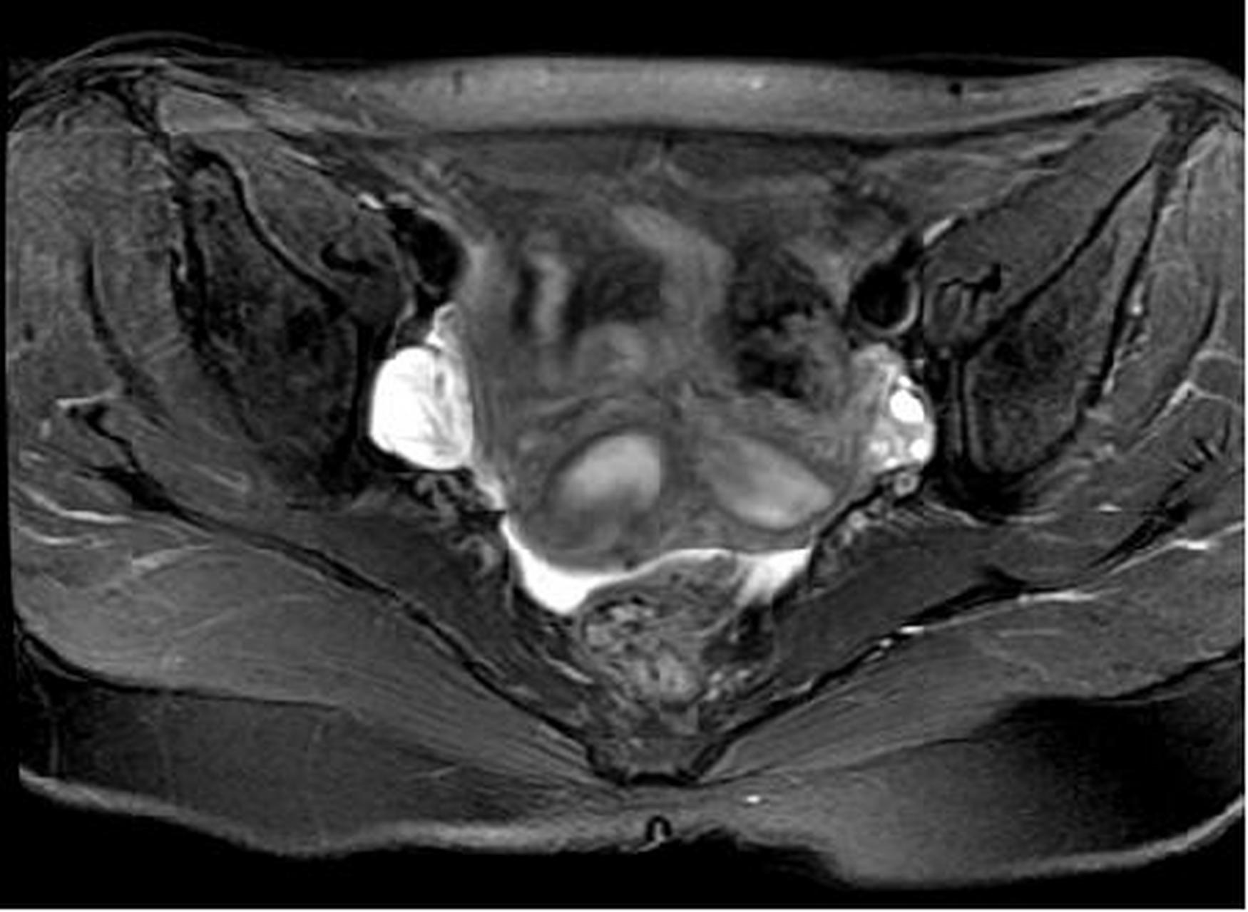 磁共振显示:双子宫畸形医学影像 人体结构 子宫 畸形