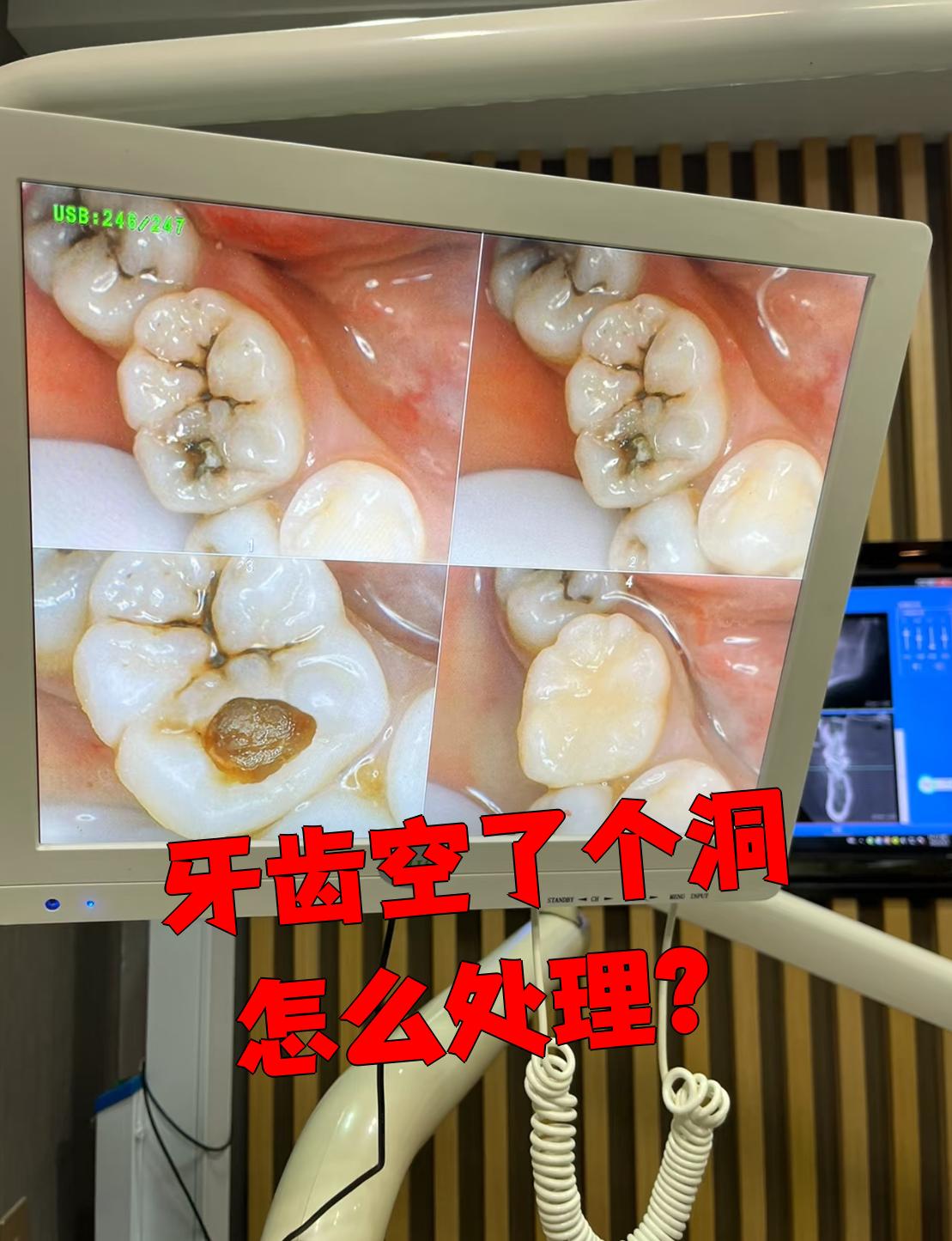 牙齿上出现空洞需要先检查洞的大小,深度和根尖状况,再决定做充填